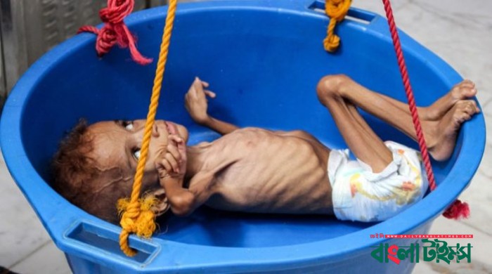 Yemen hospital struggles with number of malnourished children